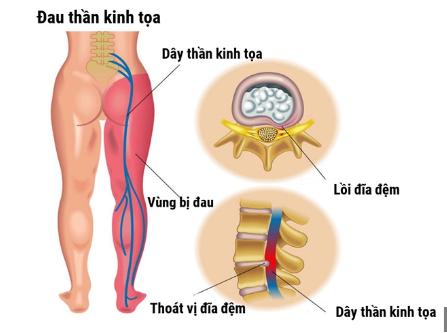 Đau thần kinh tọa - Nguyên nhân và cách giúp cải thiện - Ảnh 1.