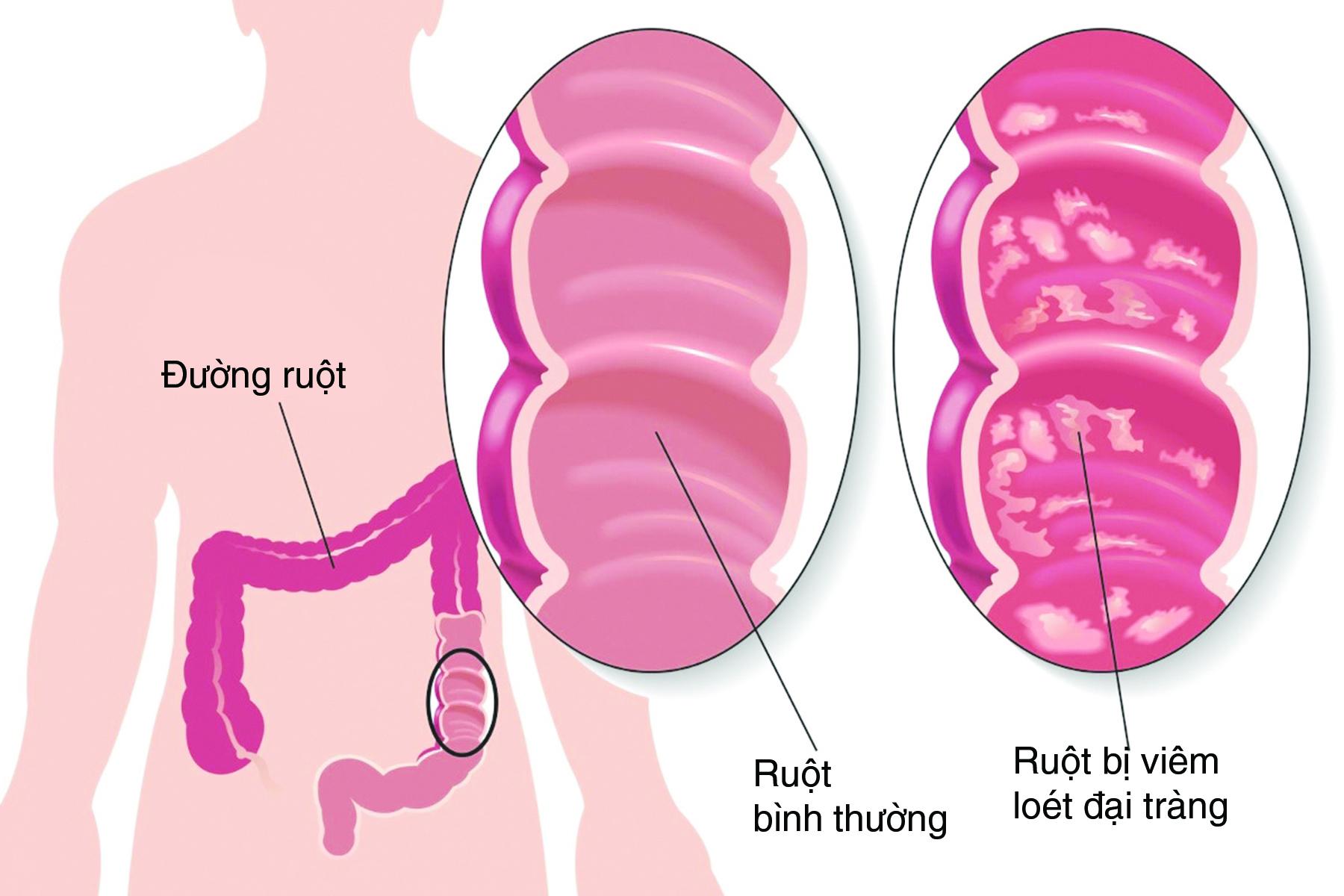 Viêm đại tràng mãn tính có nguy hiểm không? - Ảnh 1.