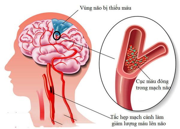 Thiếu máu não là tình trạng lượng máu cung cấp lên não không đủ khiến tế bào não không được cung cấp đủ oxy và các chất dinh dưỡng cần thiết. Ảnh minh họa