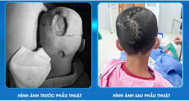 Bé 7 tuổi ở Phú Thọ bị hoại tử, trũng da đầu, bố mẹ thừa nhận sai lầm khi chữa trị cho con - Ảnh 2.