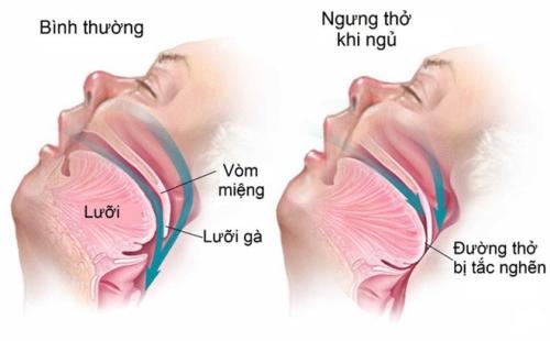 Thường buồn ngủ ban ngày, ngáy, mệt mỏi khi thức dậy, bạn nên chú ý đến hội chứng nguy hiểm này - Ảnh 1.