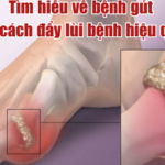 Tìm hiểu về bệnh gút và cách hỗ trợ kiểm soát bệnh