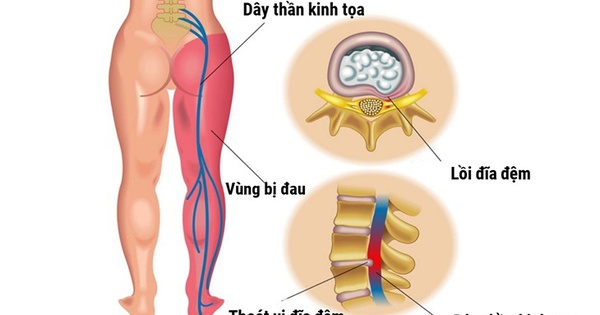 Đau thần kinh tọa - Nguyên nhân và cách hỗ trợ cải thiện