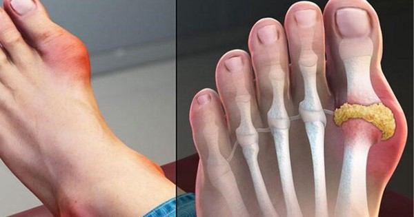 Điều trị bệnh gout cần lưu ý 3 điều sau