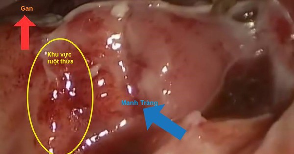 Đau bụng âm ỉ, đau bụng quanh rốn cảnh giác với viêm ruột thừa