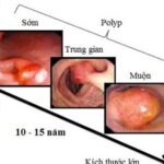 Người đàn ông ở Phú Thọ phát hiện mắc ung thư trực tràng từ một dấu hiệu nhiều người Việt bỏ qua